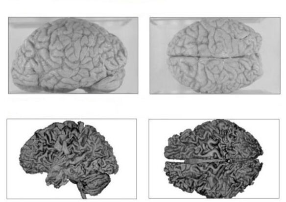 Sveiko žmogaus smegenys (viršuje) ir alkoholiko smegenys su negrįžtamomis pasekmėmis (apačioje)